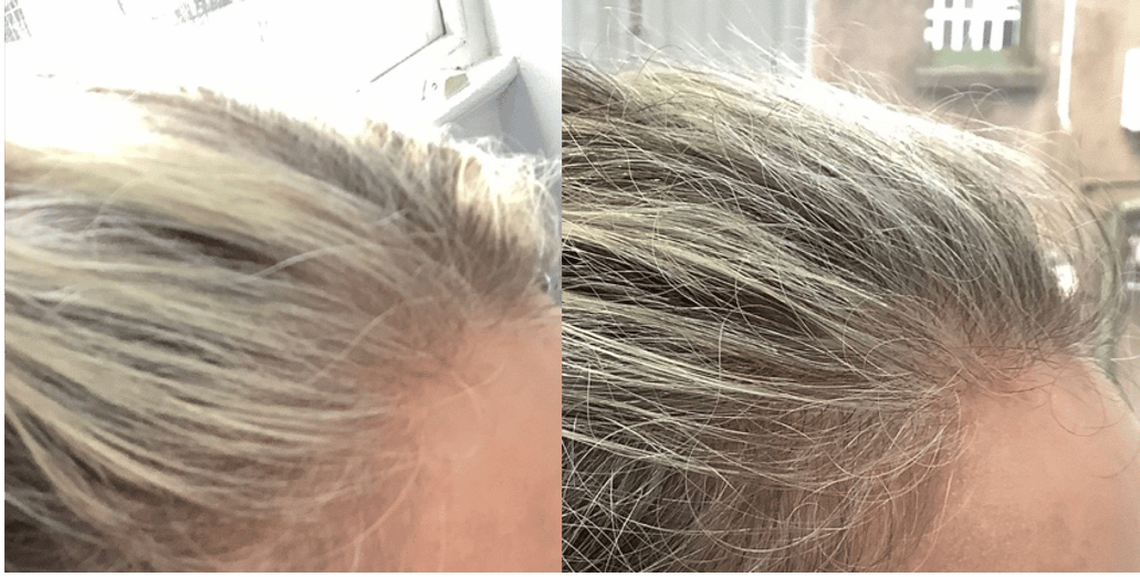 STEM CELL INFUSED PRP ™ - Advanced Hair Studio