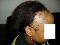 Traction Alopecia - small