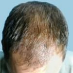 hair transplant surgery One week after