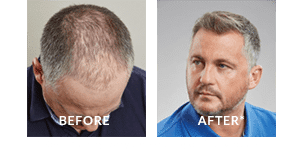 Darren Gough Before After Hair Loss