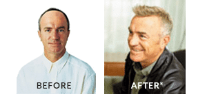 Greg Matthews Hair Loss Before After