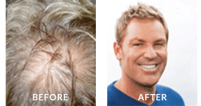 Shane Warne Before After Hair Loss