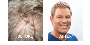 Shane Warne Before and After Hair Loss