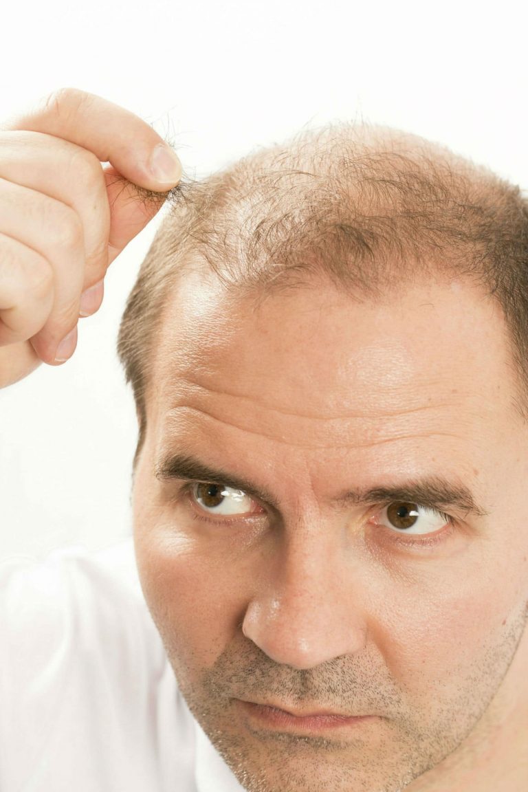 "How to Reduce & Stop Hair Falling Out Hair Loss & Balding Prevention