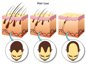 Infected Hair Follicles - Treatment To Prevent & Stop Hair Loss