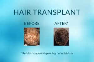 Hair Transplant Before and After