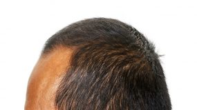 How to Get Rid of A Widows Peak