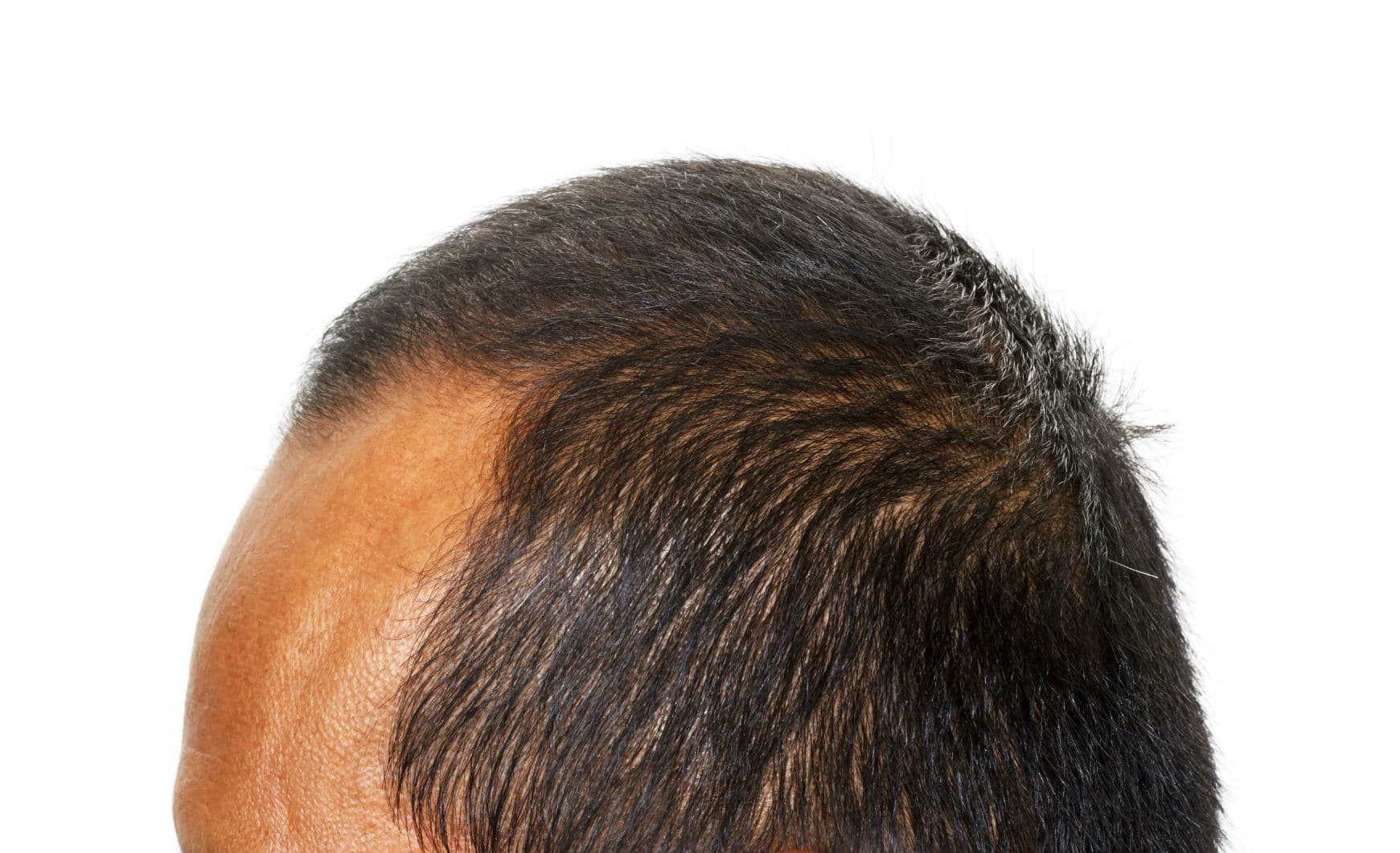 Hairstyle advice for long forehead with thin hair and widows peak