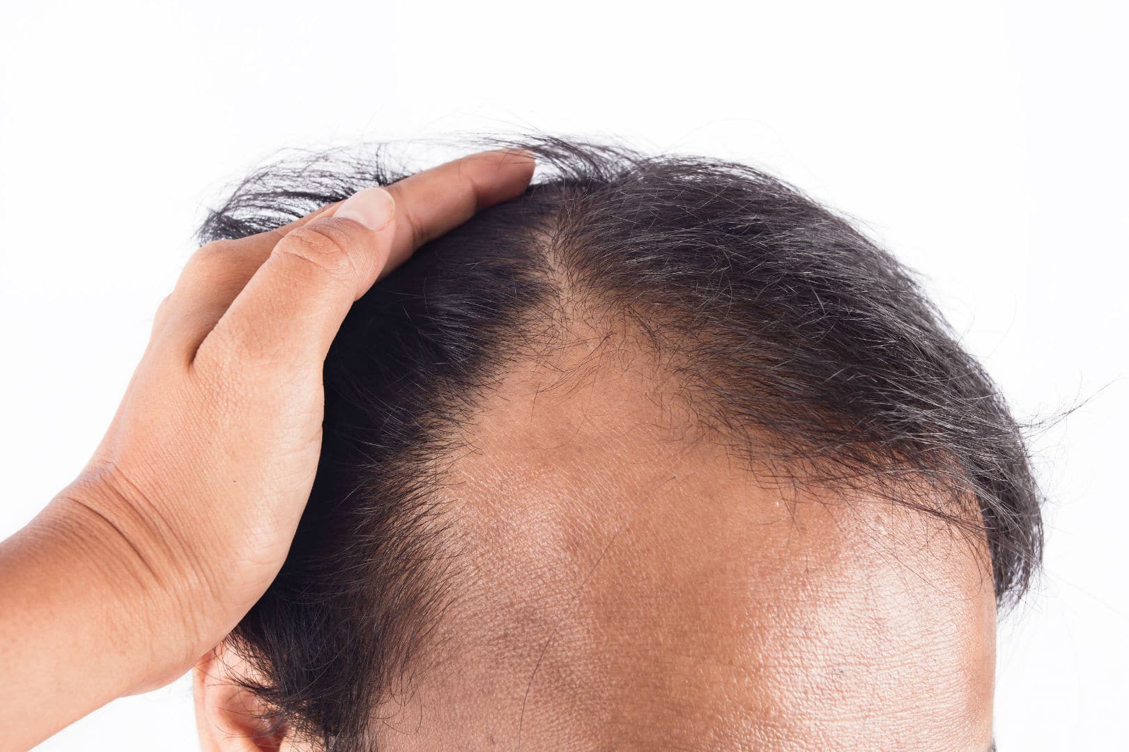 Bald Spot on The Back of Head - How to Prevent & Treat Hair Loss