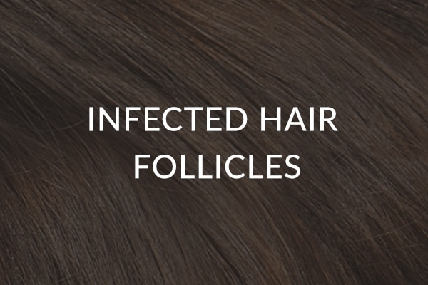 Infected Hair Treatment - Therapies To Prevent & Stop Hair Loss