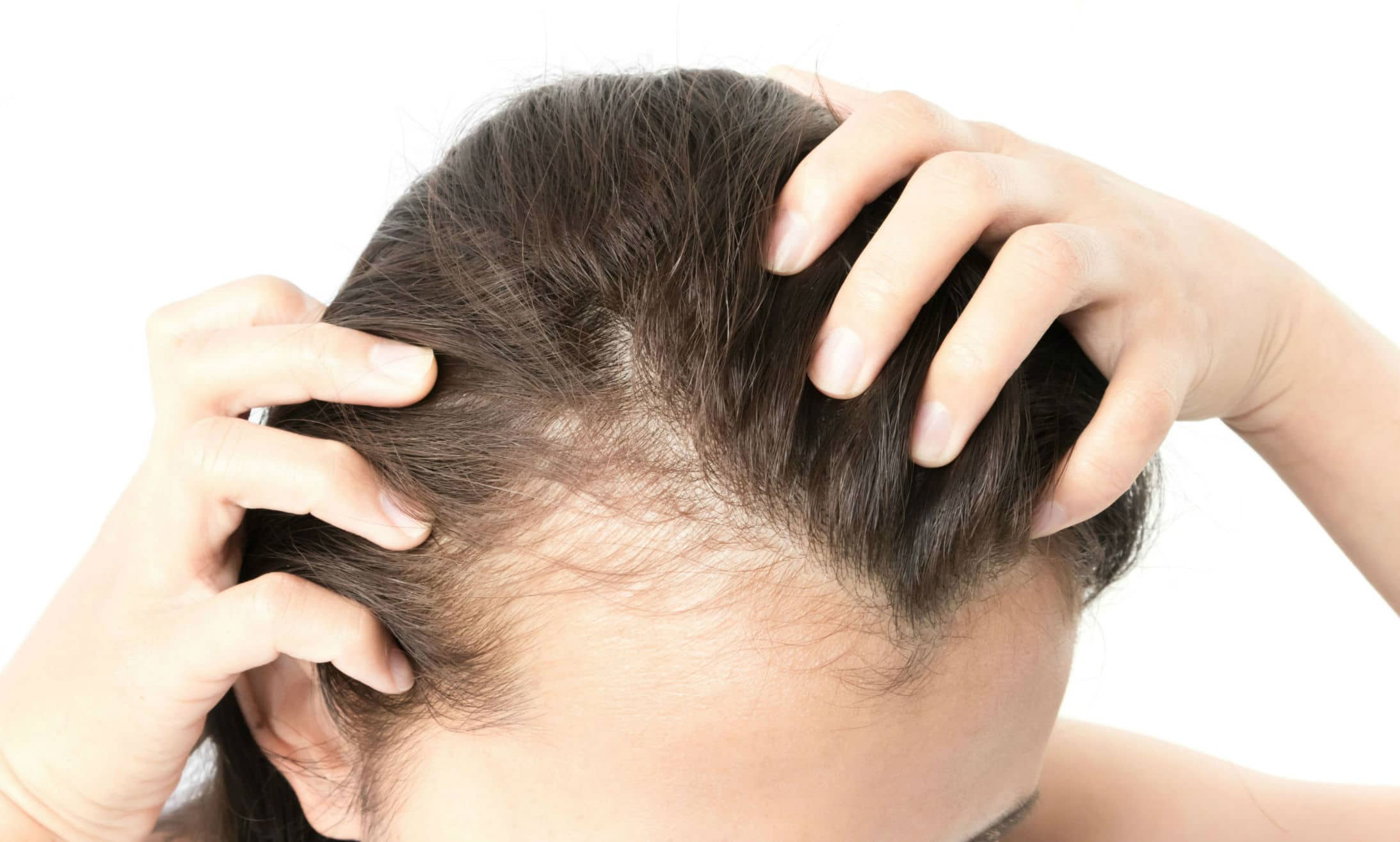 Hair Transplants For Women - Best Female Procedures by Surgeons