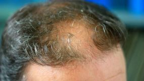 Hair Implants Cost That Everyone Can Afford
