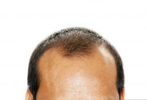 Hair Thinning at Crown