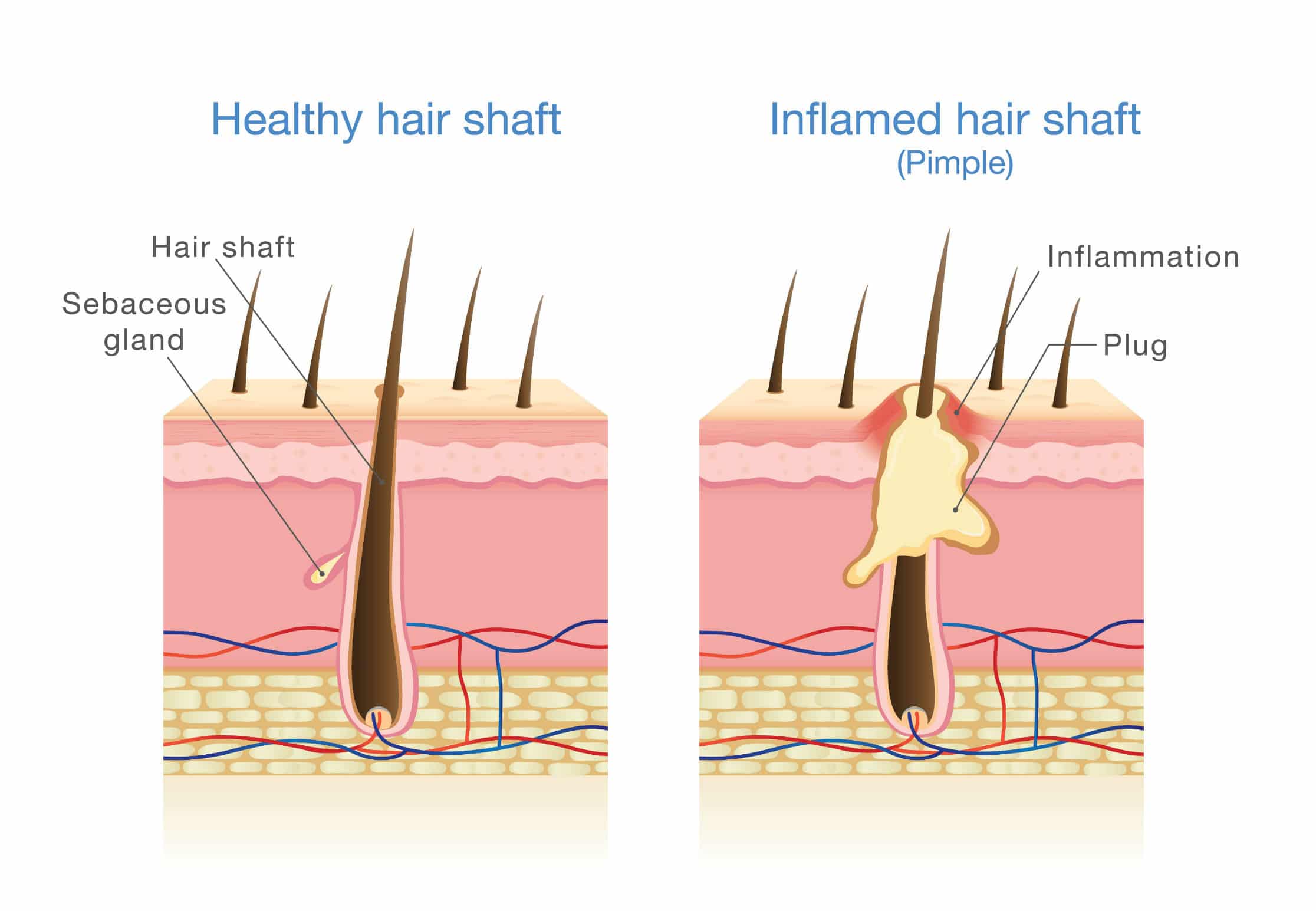 Inflamed Hair Follicles - Head / Scalp Folliculitis Treatment