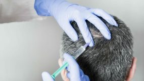 Microneedling with PRP For Hair Loss