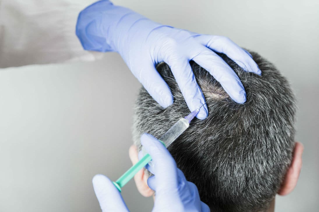 Microneedling With PRP For Hair Loss - Growth Cell Infused PRP Microneedling With PRP For Hair Loss - Growth Cell Infused PRP