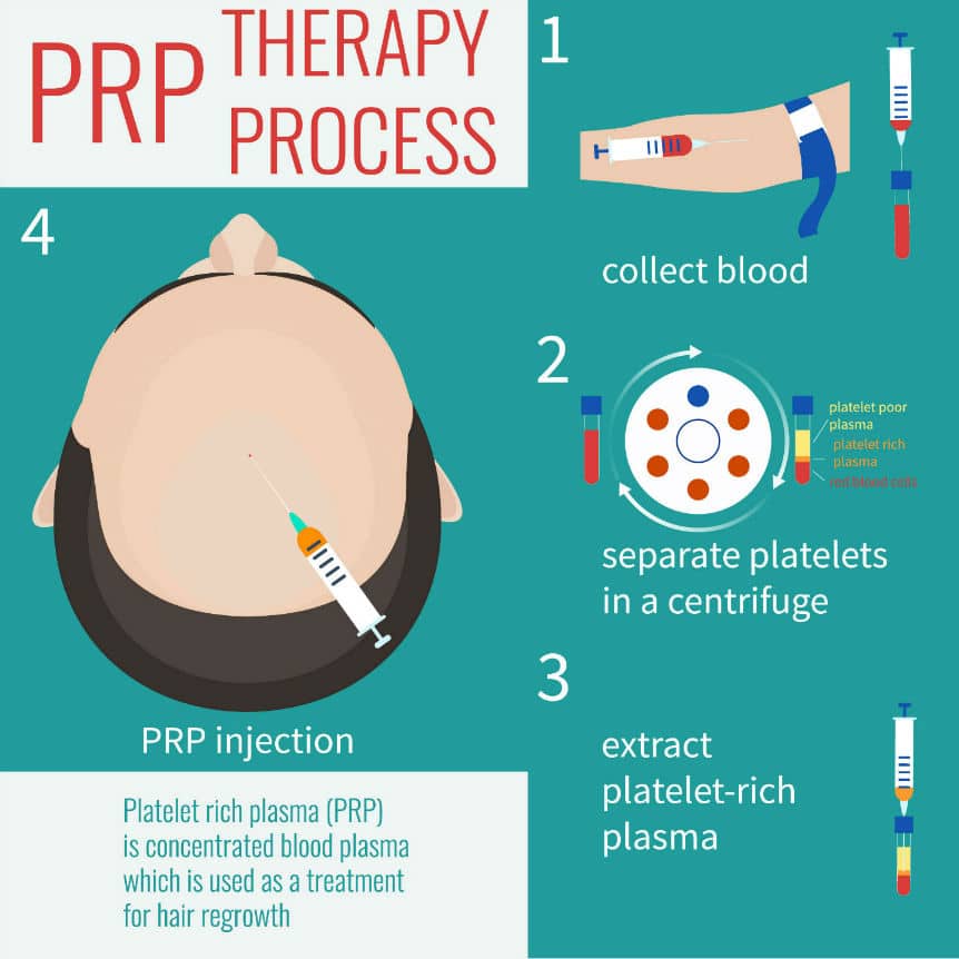 What is PRP Treatment - Therapy Procedure For Hair Loss