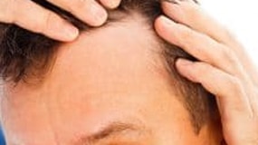 hair loss symptoms