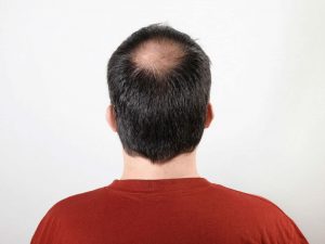 What Is A Crown Hair Transplant?