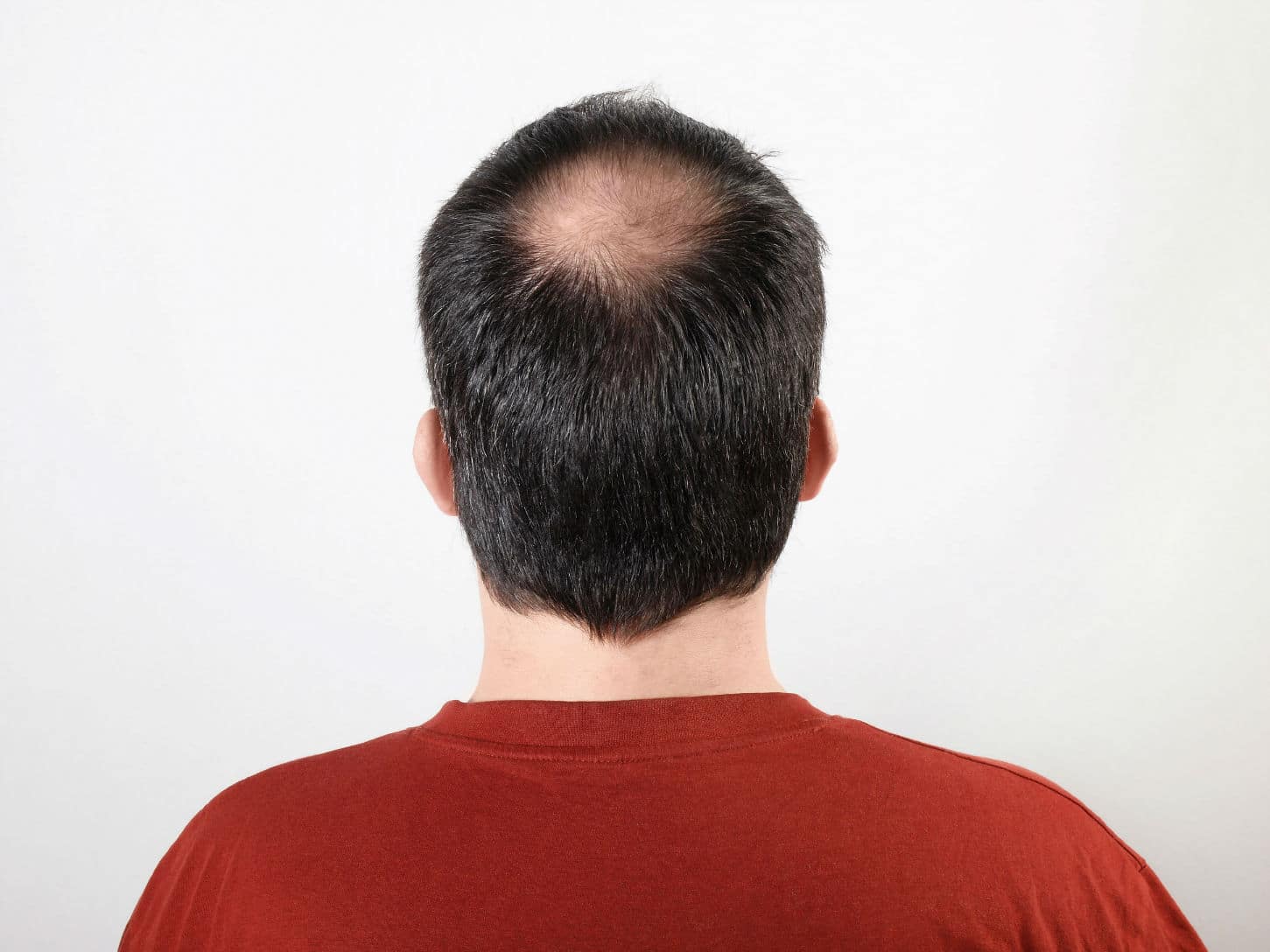 Bald Spot On Crown Causes Ways To Hide  Treatments  Longevita