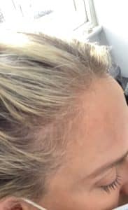 Before Woman Hairline