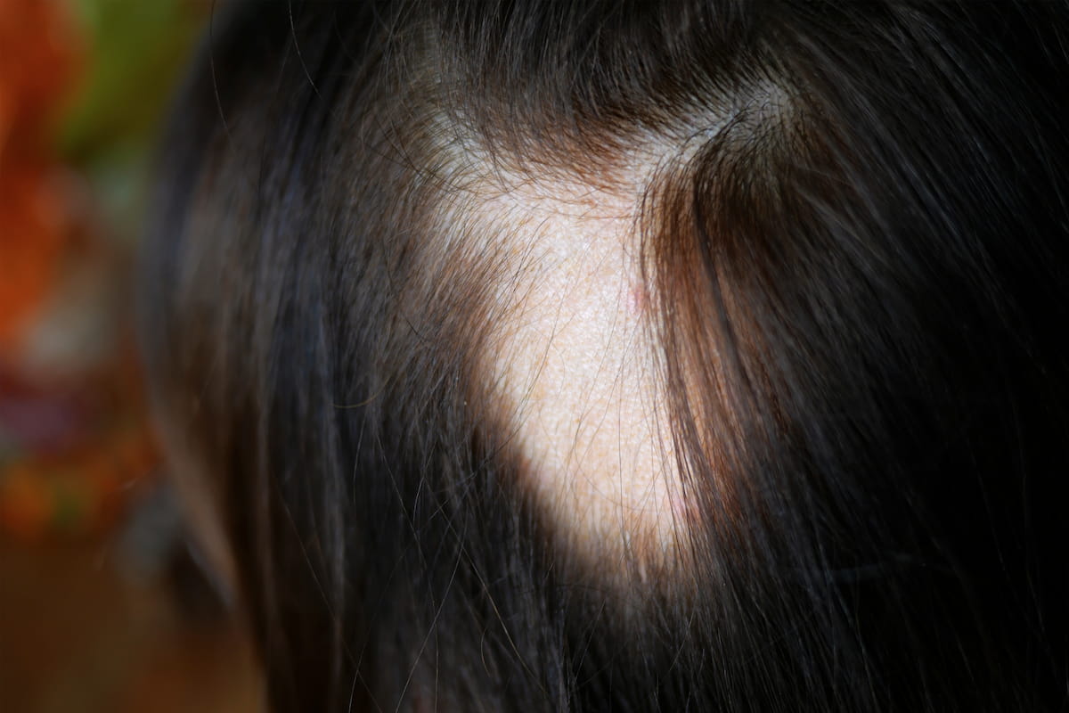 Is Alopecia Genetic? We Answer All Your Hair Loss Questions