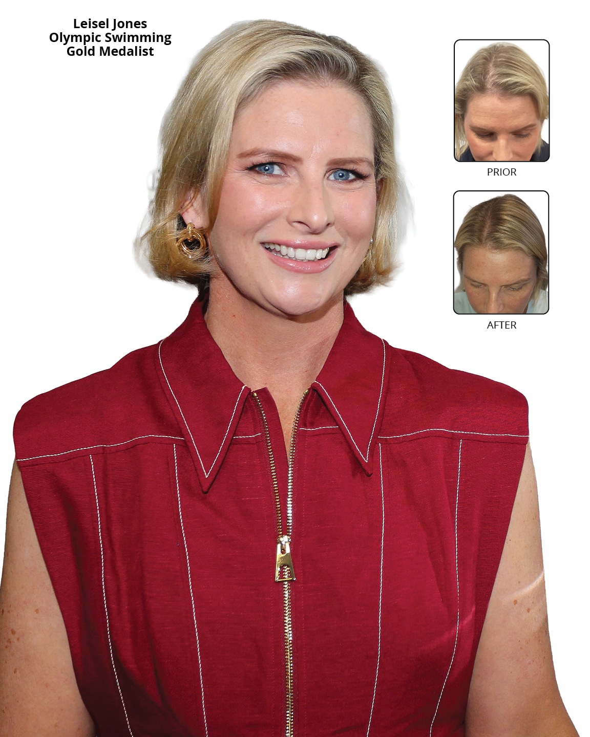 Advanced Hair Leisel Jones Before And After