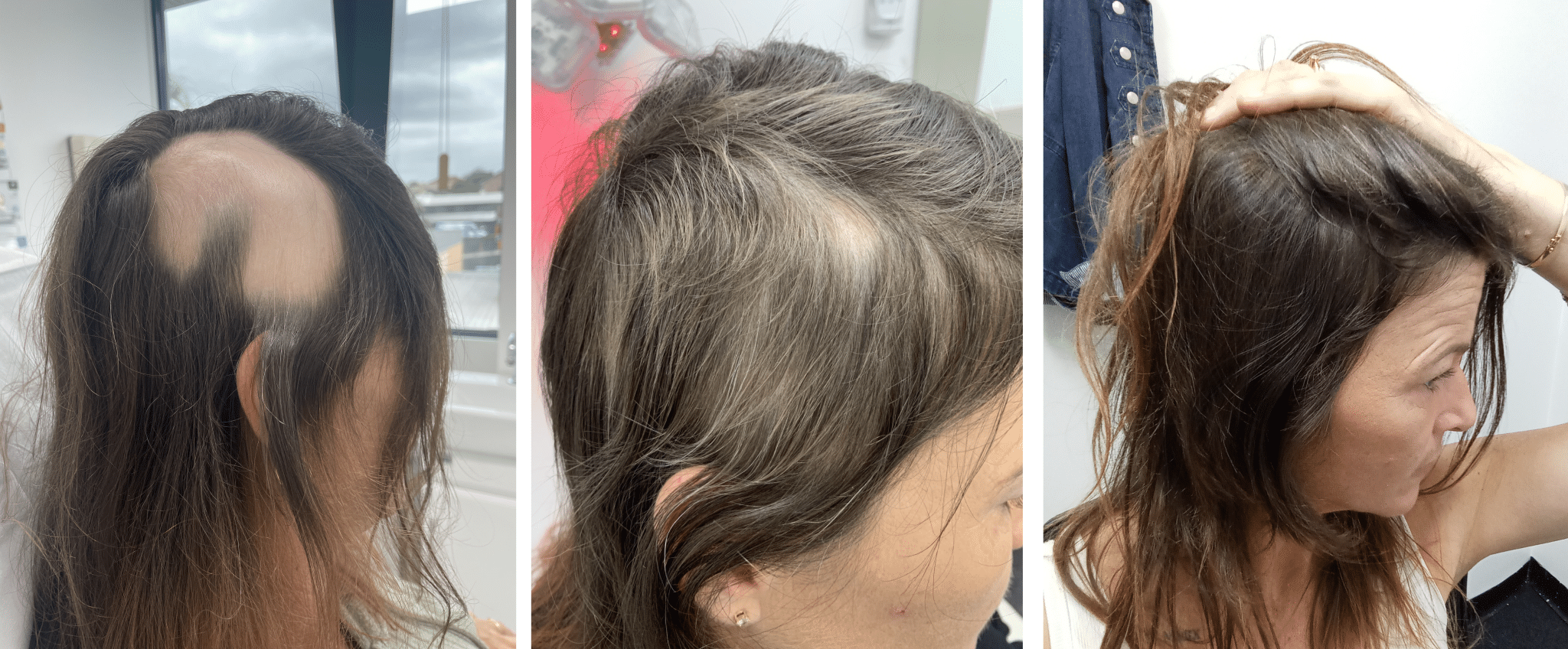 Advanced Hair Stem Cell Infused PRP Plus PRP and Advanced Laser Therapy