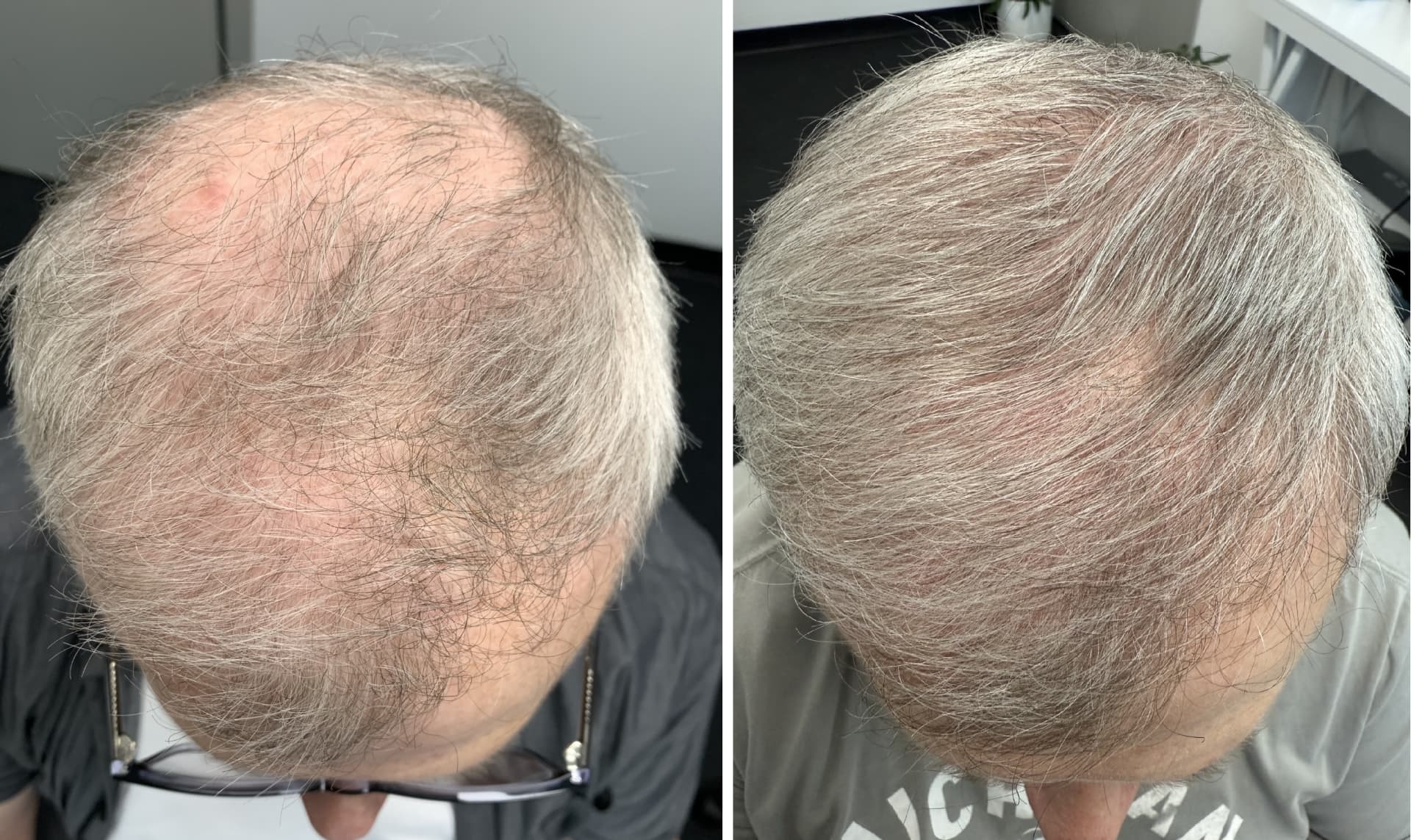 Advanced Hair Strand By Strand Before And After