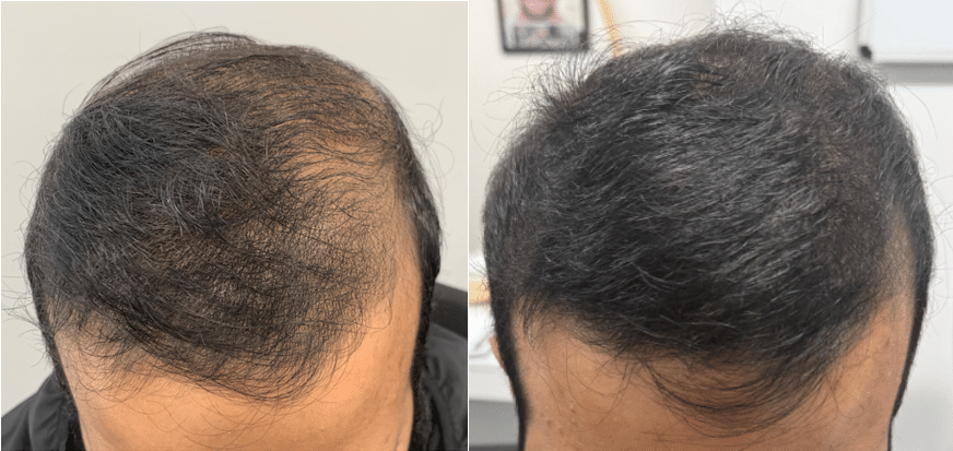 Frontal Pre SCIPRP June 2025 Vs October 2025 Scaled